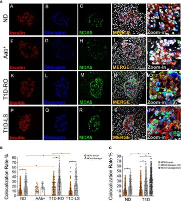 Increased Expression of Viral Sensor MDA5 in Pancreatic Islets and in Hormone-Negative Endocrine Cells in Recent Onset Type 1 Diabetic Donors